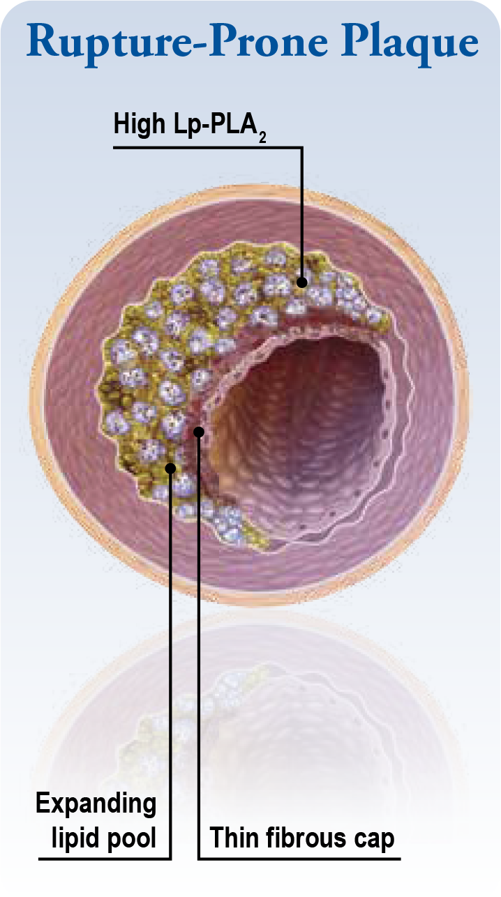 rupture-prone-plaque