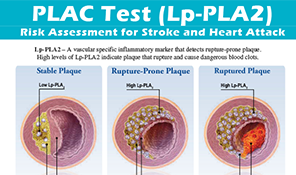 The PLAC® Test Clearly Identifies Active Cardiovascular Inflammatory Disease